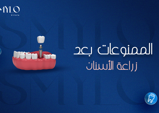 الممنوعات بعد زراعة الأسنان