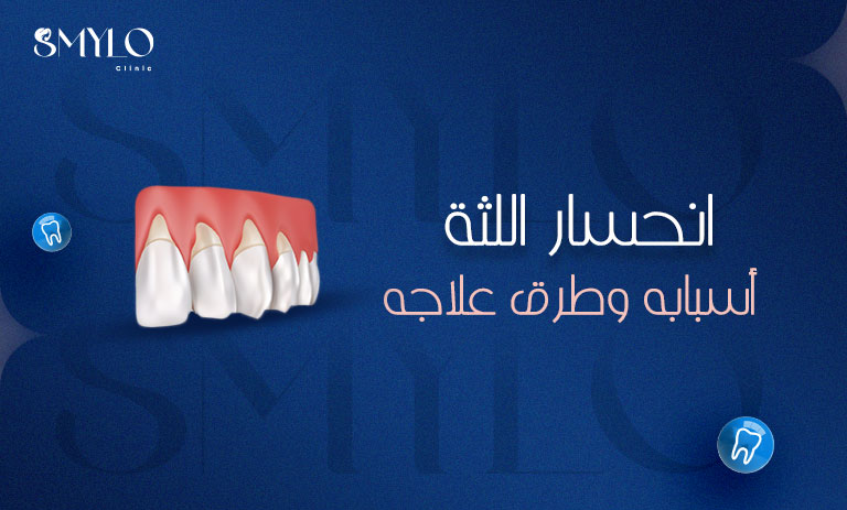 انحسار اللثة