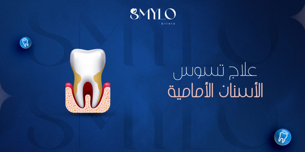 علاج تسوس الأسنان الأمامية