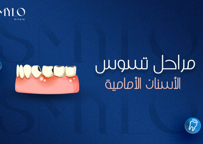 مراحل تسوس الأسنان الأمامية