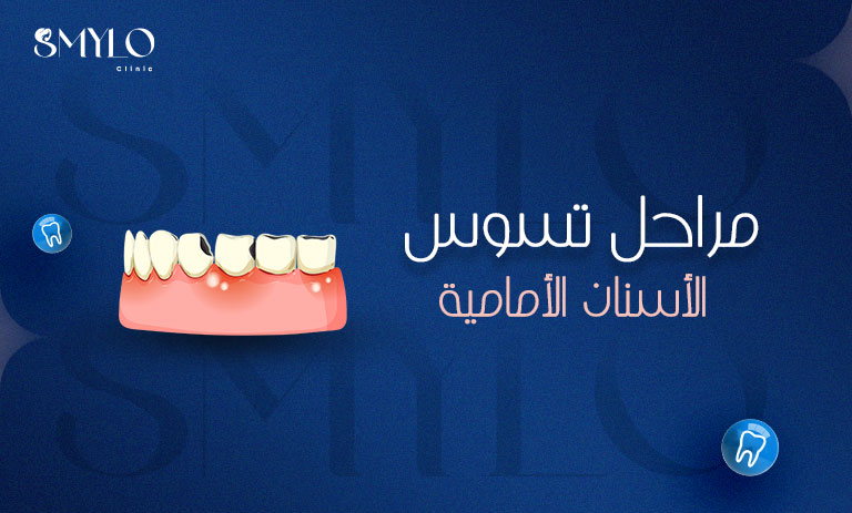 مراحل تسوس الأسنان الأمامية