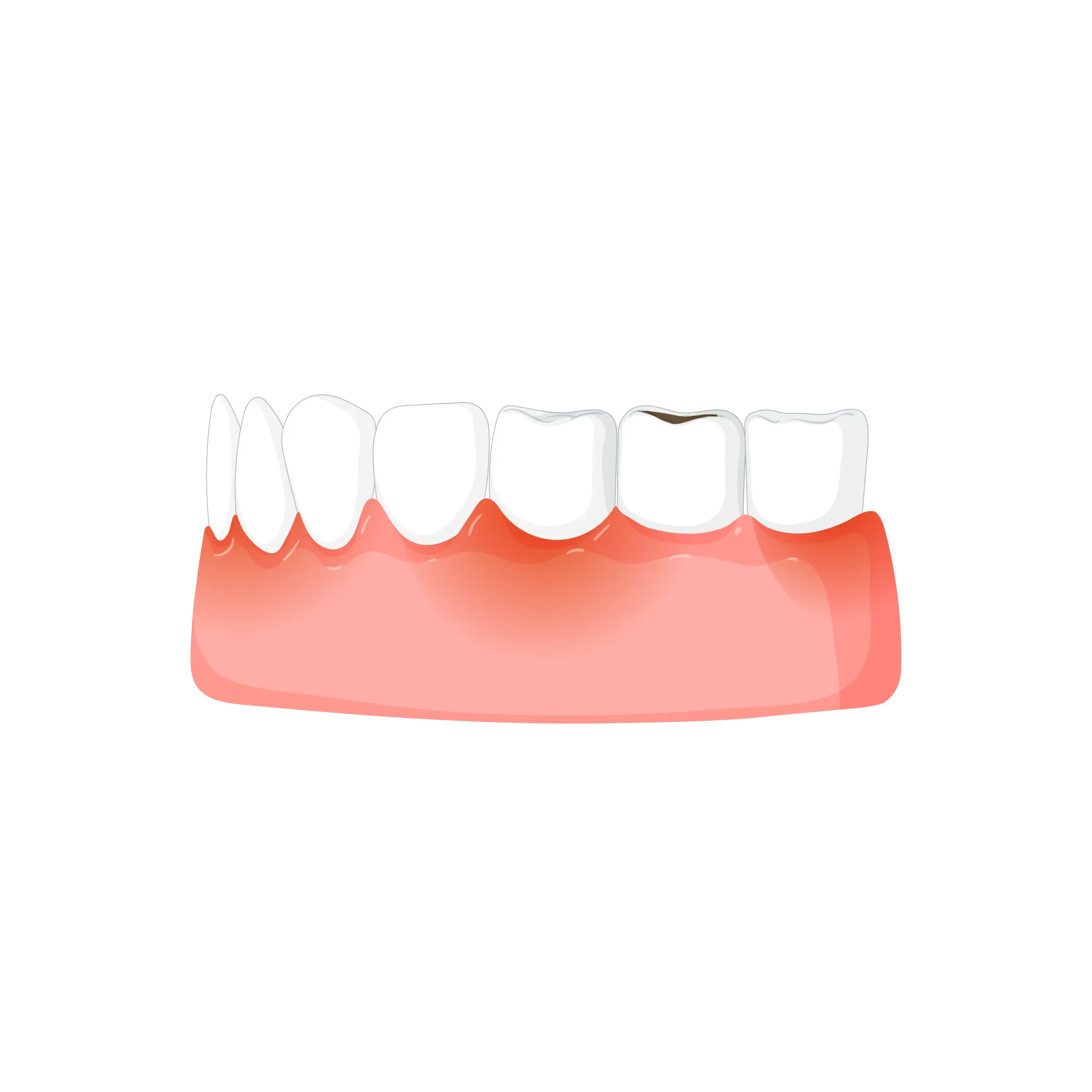 Gum Recession Surgery