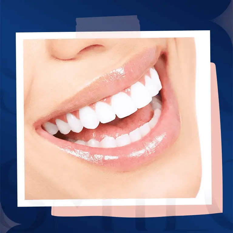 hollywood smile