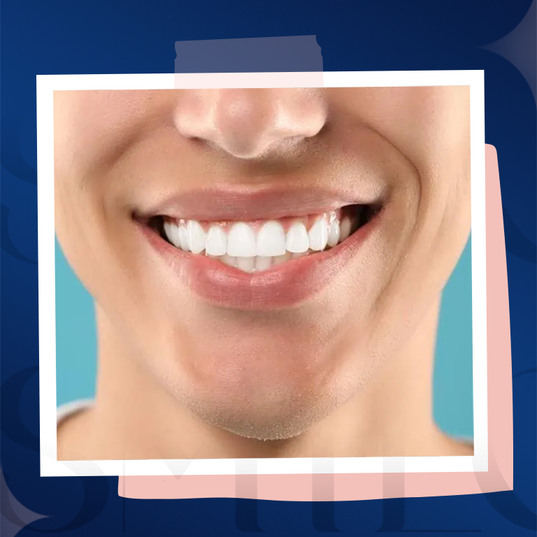 TI Smile