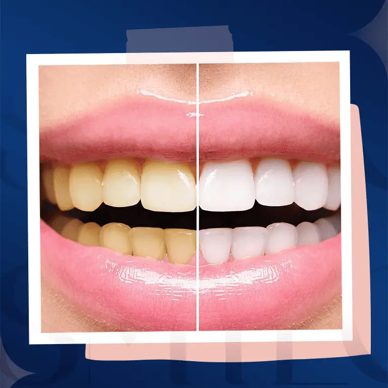 teeth whitening