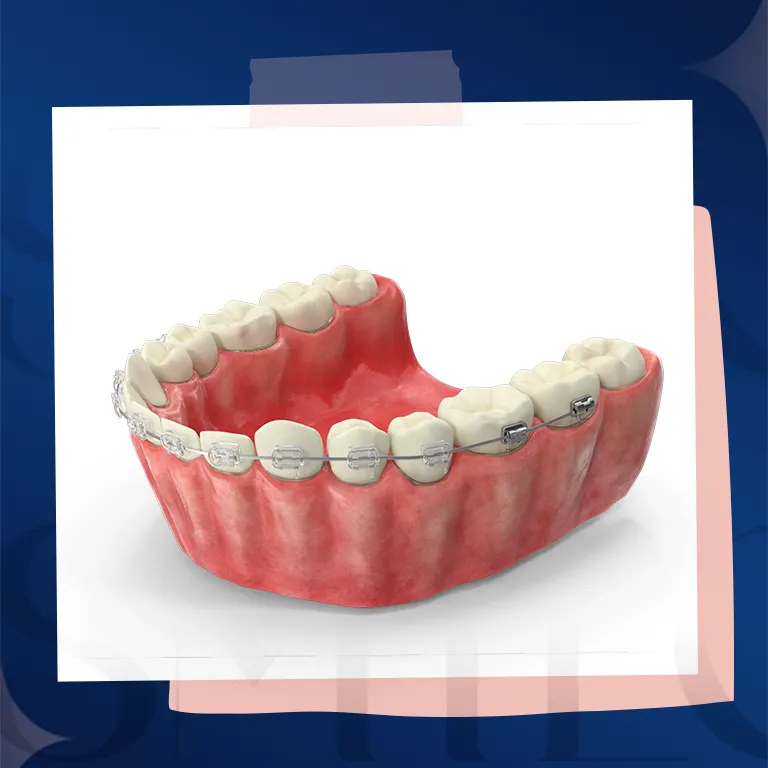 ceramic braces