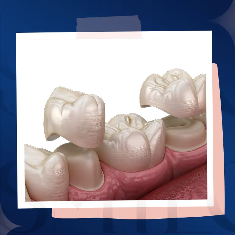 composite filling