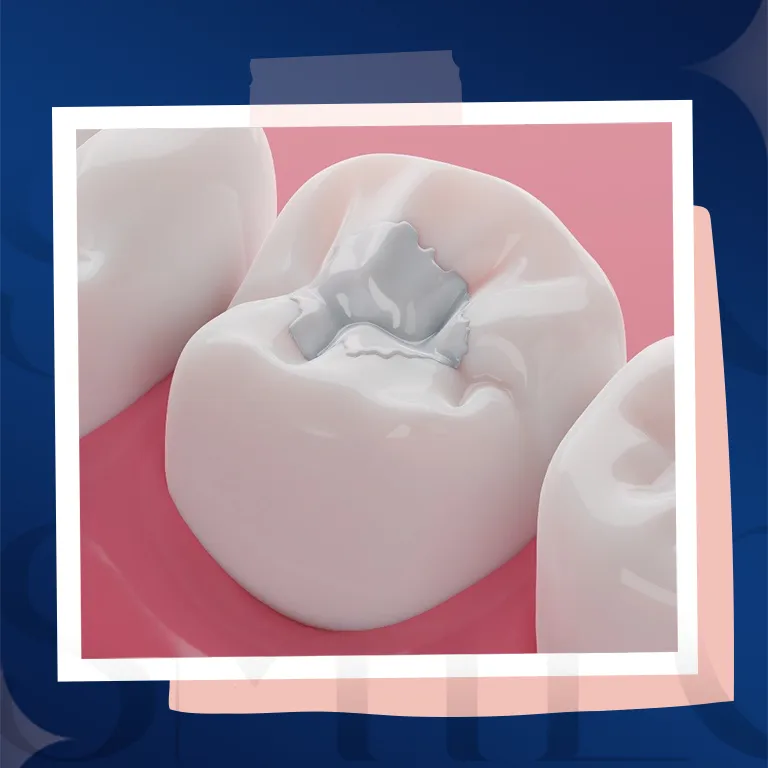 ceramic filling