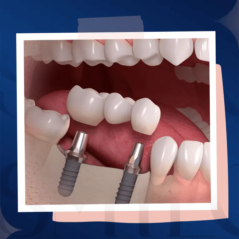 dental implants