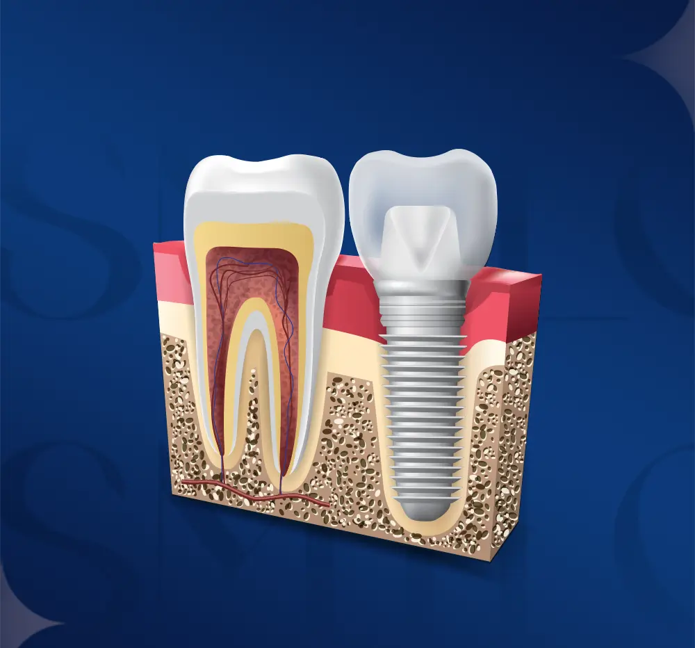 dental prosthetics