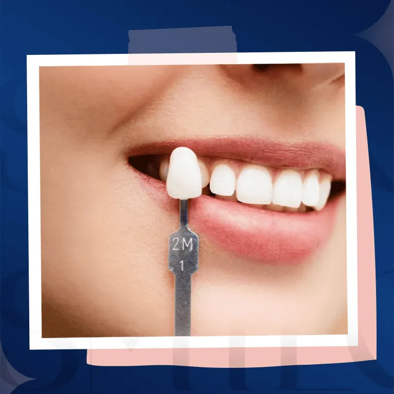 dental veneers