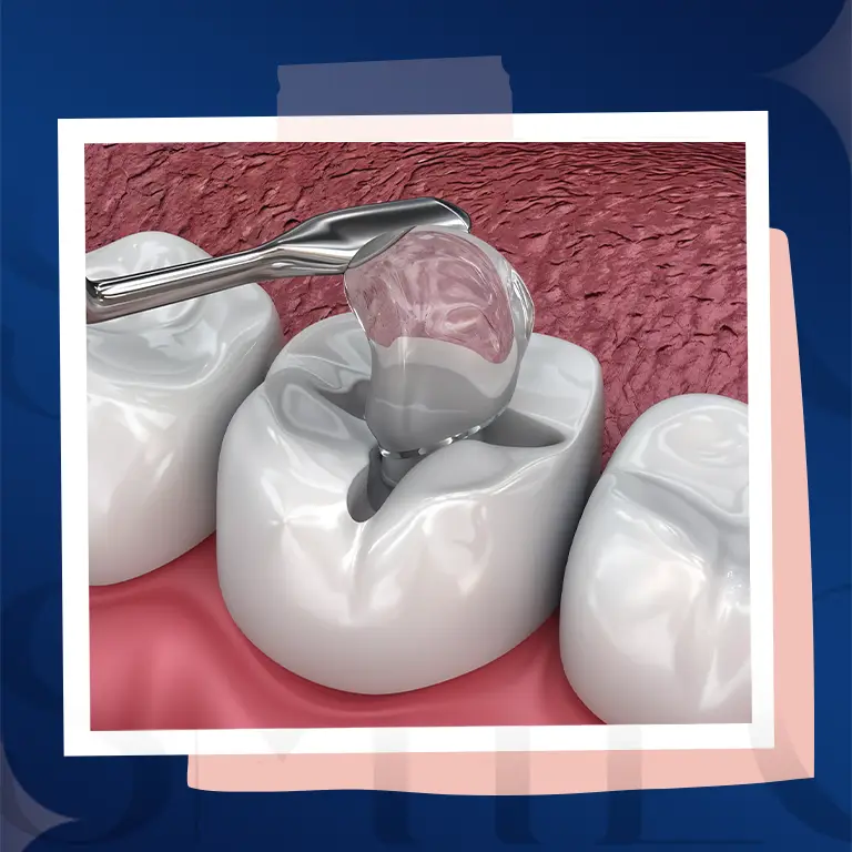glass ionomer filling