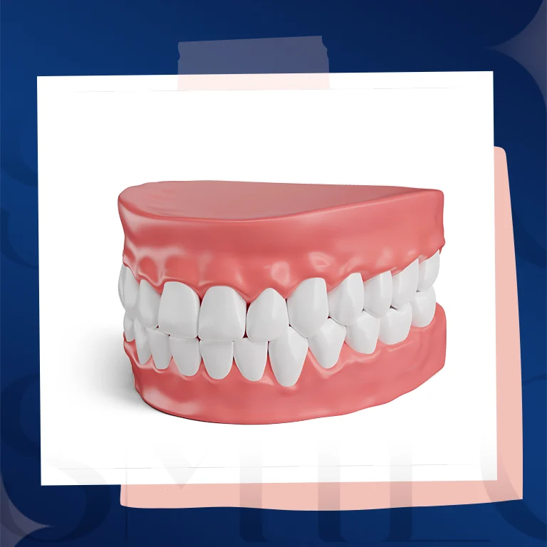 lingual braces