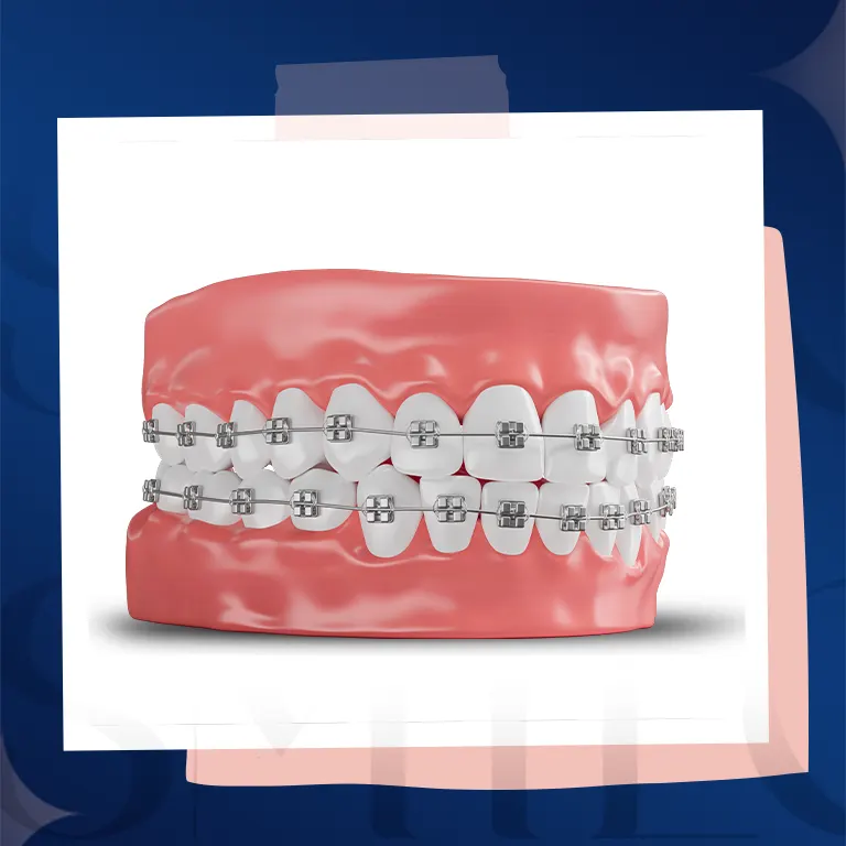metal braces