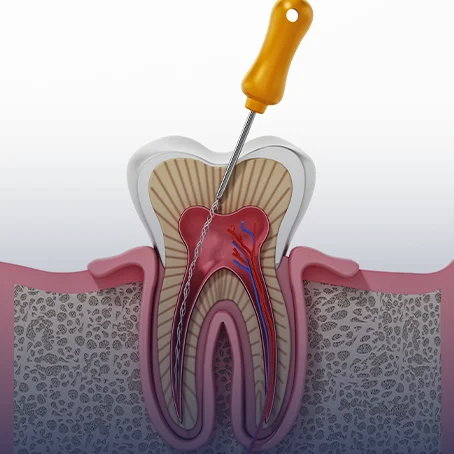 root canal treatment
