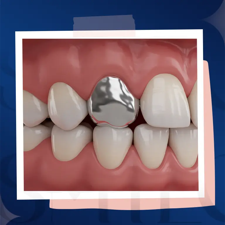 amalgam silver filling