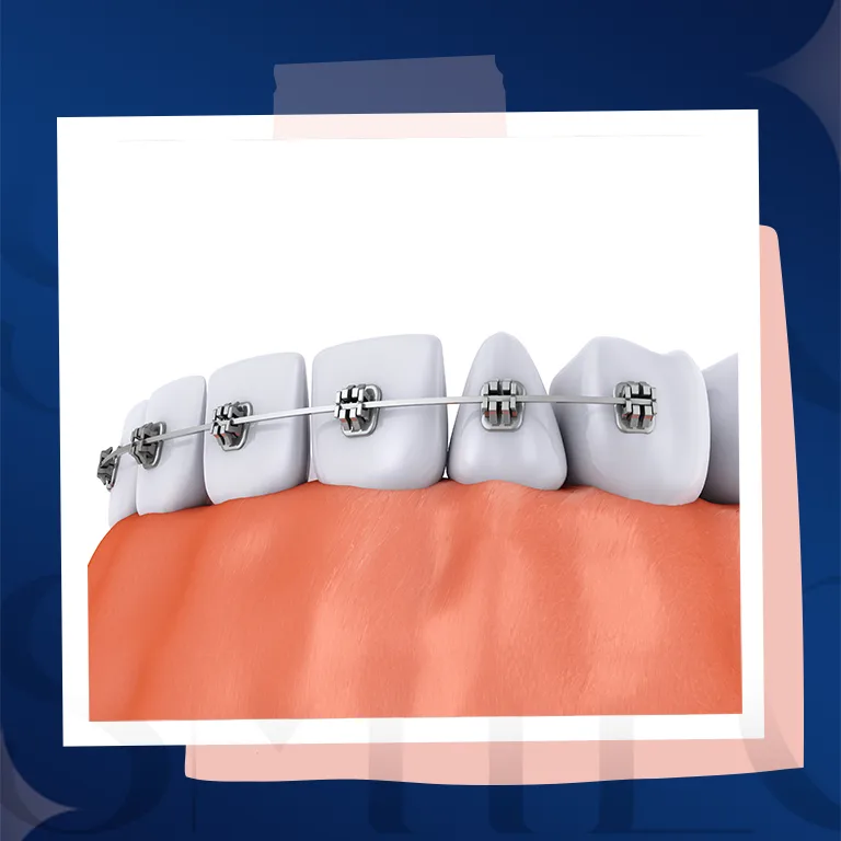 surgical braces