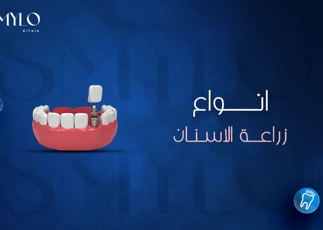أنواع زراعة الأسنان