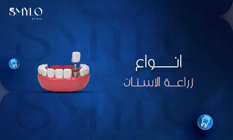 أنواع زراعة الأسنان