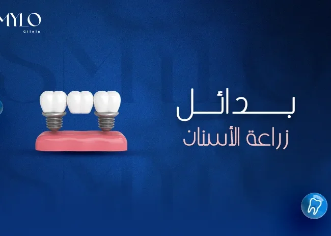 بدائل زراعة الأسنان