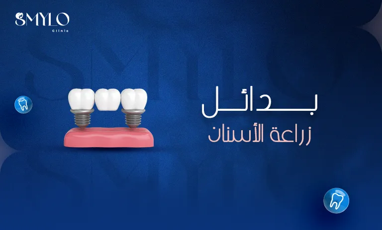 بدائل زراعة الأسنان