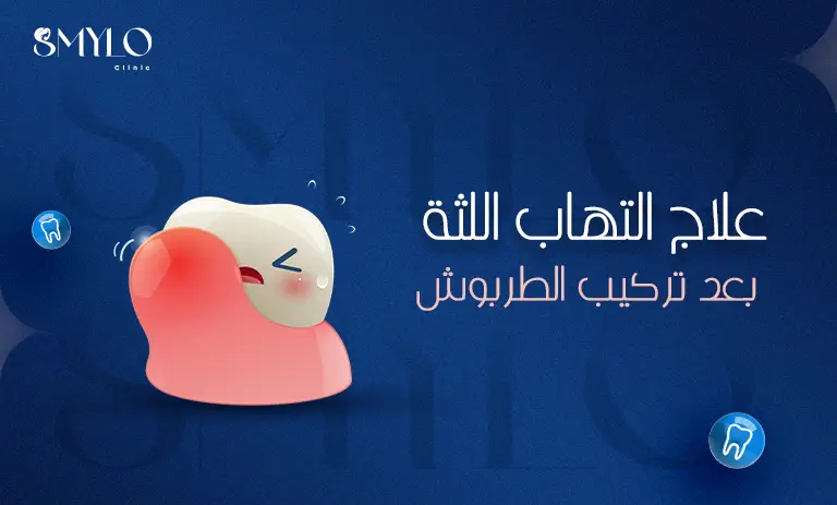 علاج التهاب اللثة بعد تركيب الطربوش
