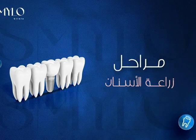 مراحل زراعة الأسنان