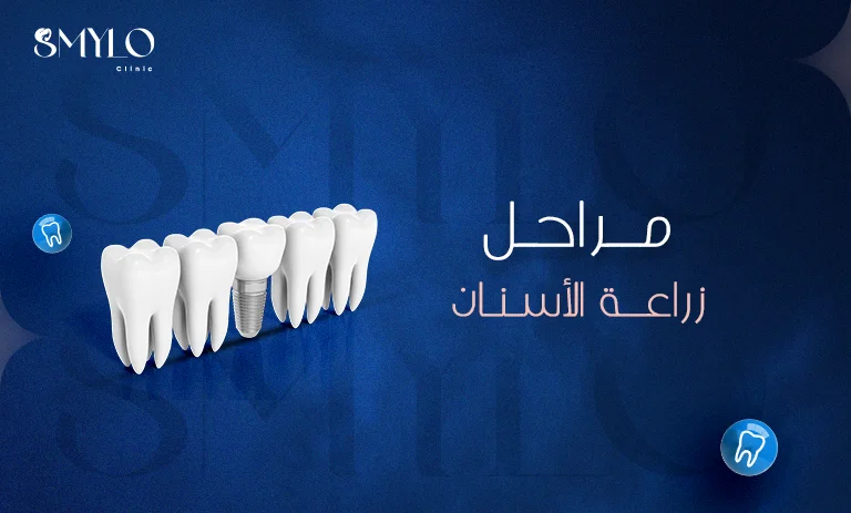 مراحل زراعة الأسنان